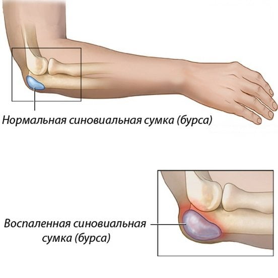 Здоровый и пораженный бурситом локтевой сустав Бурсит локтевого сустава