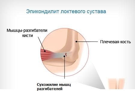 Эпикондилит локтевого сустава Эпикондилит локтевого сустава