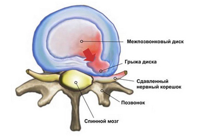 Сдавленный нервный корешок Защемление нервного корешка