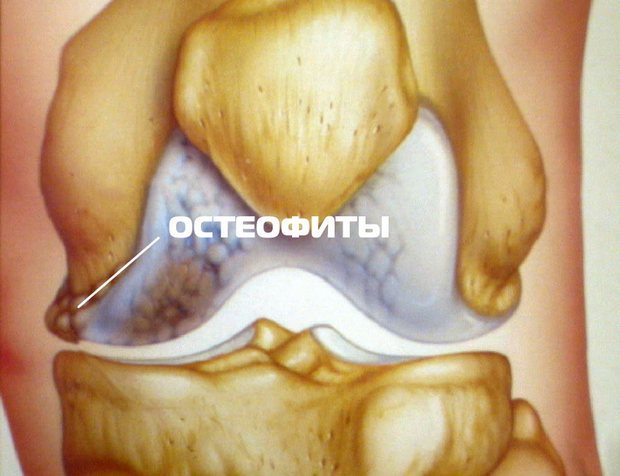 Разрастание костной ткани на коленном суставе Остеофиты на колене