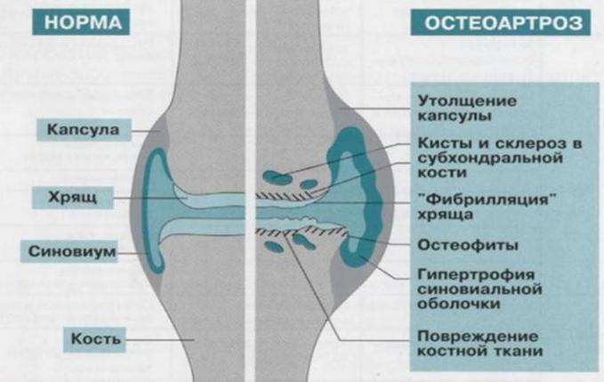 Здоровое сочленение и остеоартроз коленного сустава Остеоартроз коленного сустава