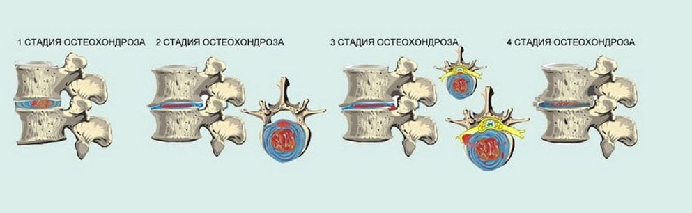 Стадии остеохондроза Стадии остеохондроза