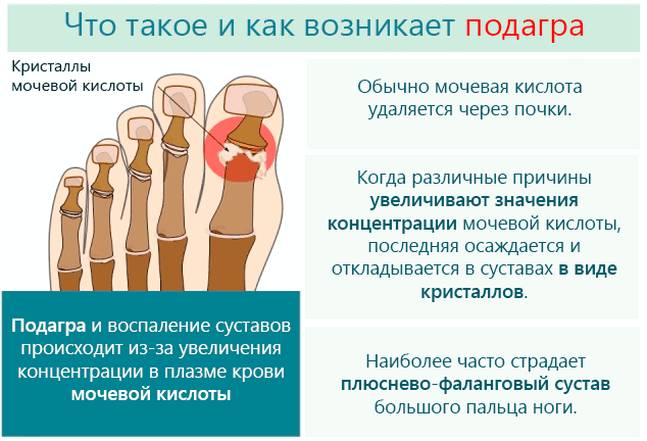 Что такое и как возникает подагра Что такое подагра