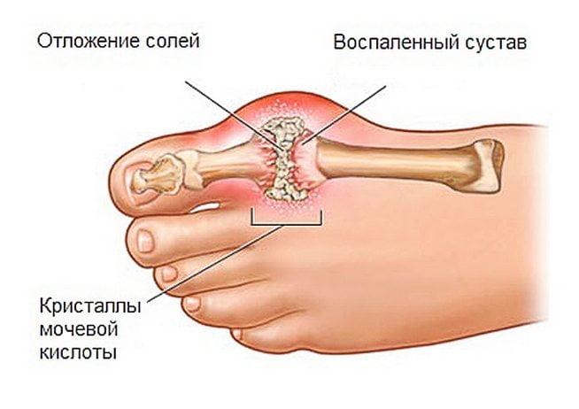 Подагра большого сустава большого пальца ноги Подагра