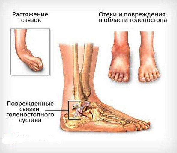 Отеки и повреждения голеностопного сустава Растяжение связок голеностопа