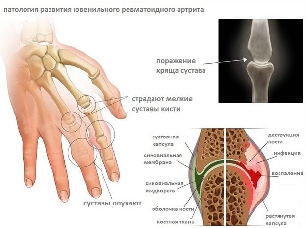 Патология развития ювенильного ревматоидного артрита Развитие ювенильного ревматоидного полиартрита