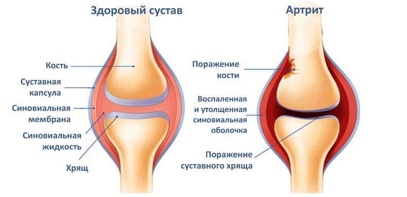 Здоровый и пораженный артритом сустав Артрит сустава
