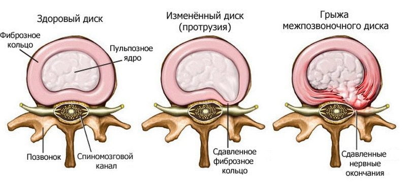 Здоровый диск, протрузия и грыжа межпозвоночного диска Грыжа межпозвоночного диска