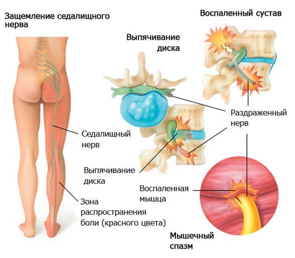 Защемление седалищного нерва, мышечный спазм Защемление седалищного нерва
