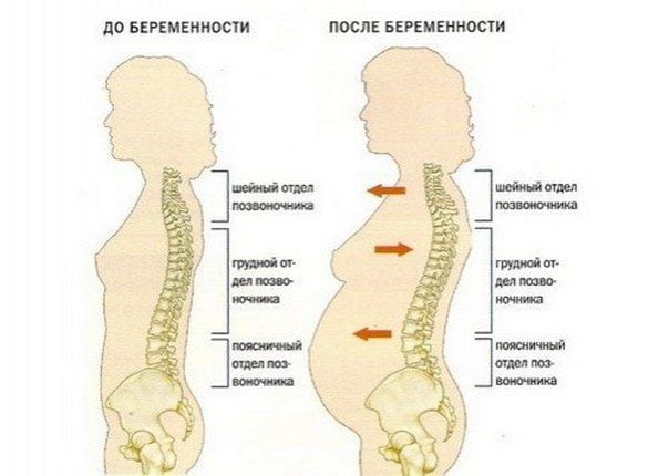 Сравнение позвоночника до и во время беременности Влияние беременности на позвоночник