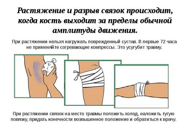 Первая помощь при разрыве ПКС Первая помощь при разрыве ПКС