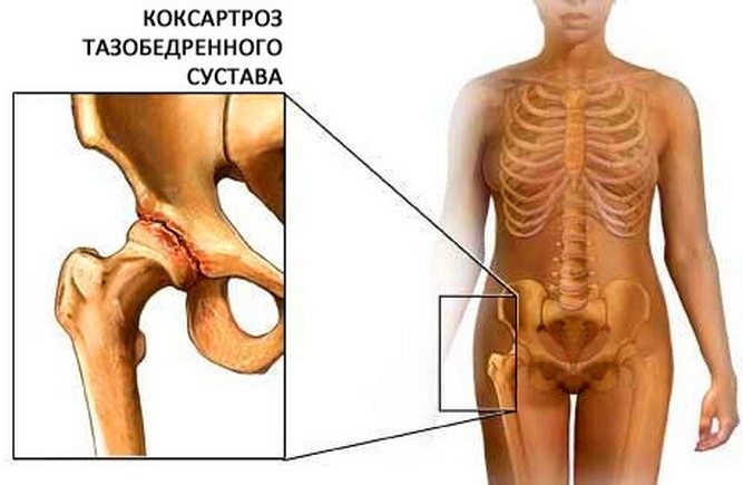 Коксартроз тазобедренного сочленения Коксартроз тазобедренного соединения