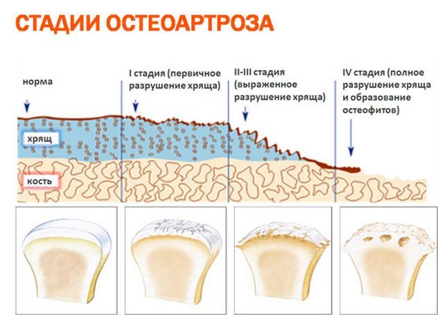 Стадии остеоартроза Остеоартроз