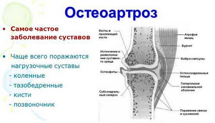 Особенности остеоартроза Остеоартроз