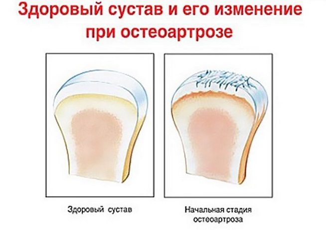 Здоровый и пораженный остеоартрозом 1 степени сустав Остеоартроз коленного сустава 1 степени