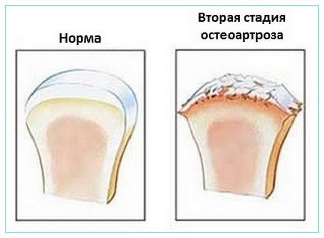 Здоровый и пораженный остеоартрозом 2 степени сустав Остеоартроз колена 2 степени