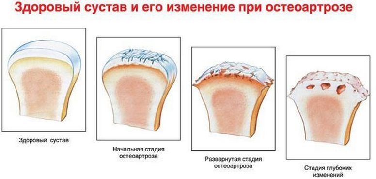 Здоровый сустав и три стадии остеоартроза Стадии остеоартроза
