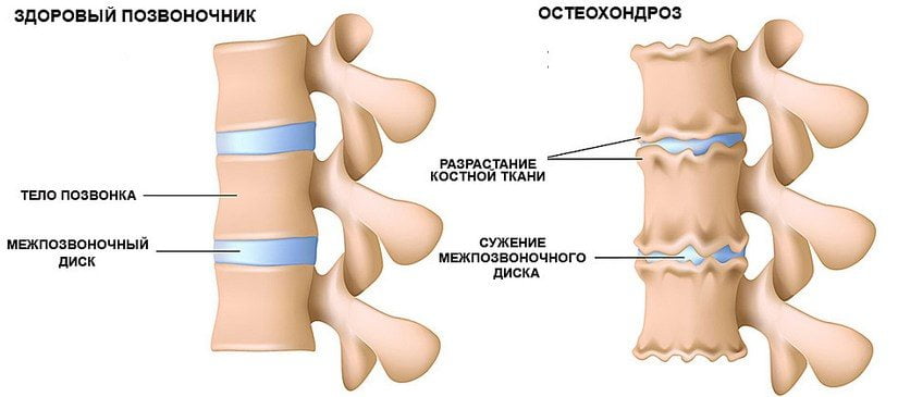 Здоровый и пораженный остеохондрозом позвоночник Остеохондроз