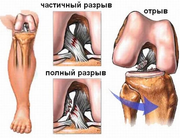 Разрыв связок коленного сустава Разрыв связок коленного сустава