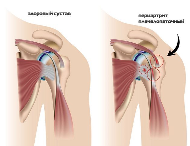 Здоровый и пораженный периартритом сустав Периартрит плечелопаточный