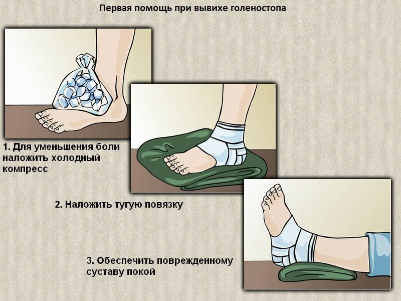 Первая помощь при вывихе голеностопного сустава Первая помощь при вывихе голеностопа