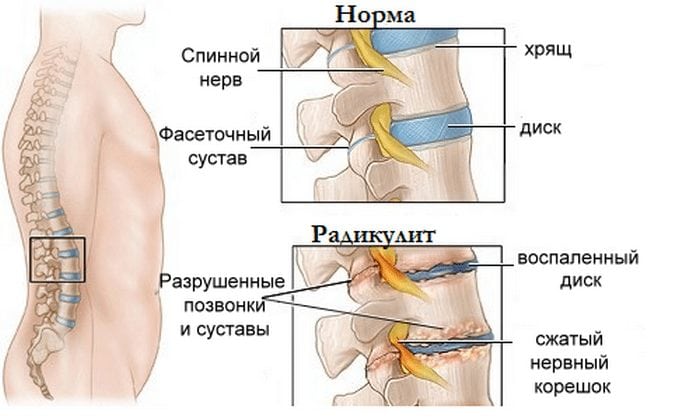Здоровые позвонки и радикулит Радикулит