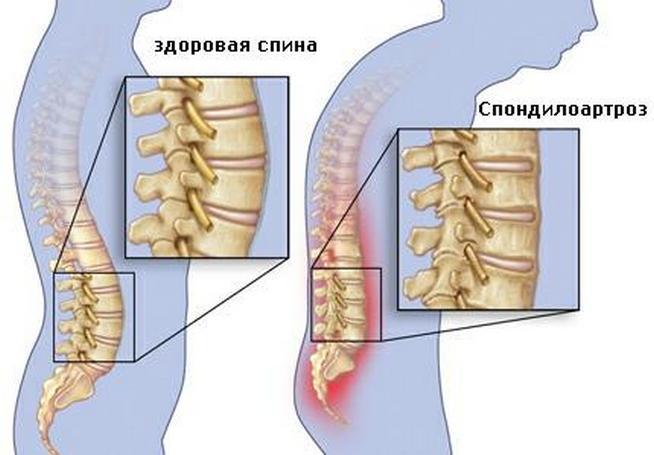 Здоровый и пораженный спондилоартрозом поясничный отдел позвоночника Спондилоартроз