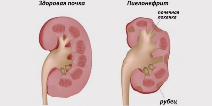 Отличие нормальной почки от поврежденной пиелонефритом Пиелонефрит