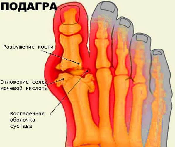 Подагра большого пальца стопы Подагра