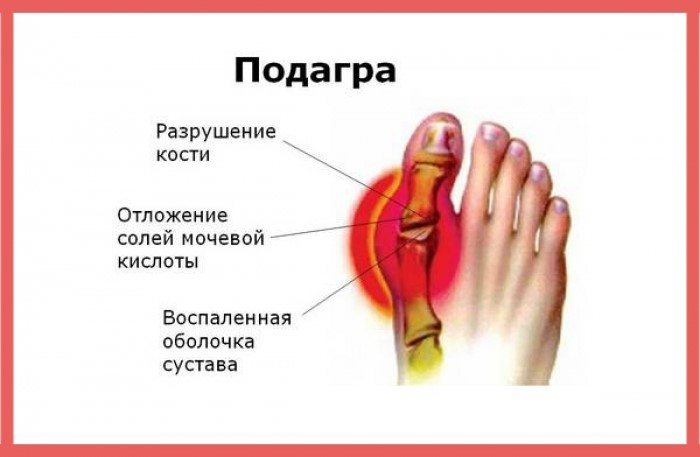 Сустав большого пальца стопы пораженный подагрой Подагра ступни