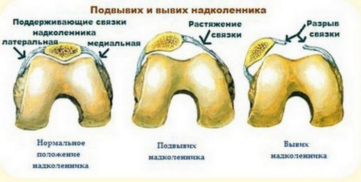 Нормальное положение надколенника, вывих и подвывих чашечки Вывих и подвывих наколенника