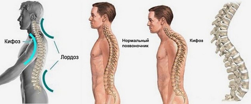 Здоровый позвоночник и развитие кифоза, лордоза Развитие кифоза и лордоза