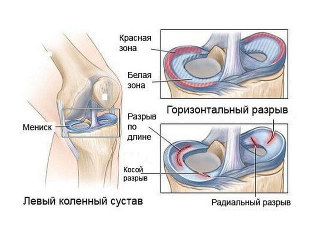 Повреждения мениска Повреждения мениска