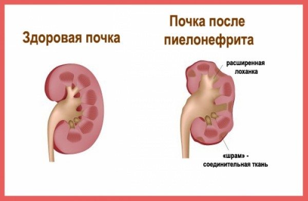 Здоровая почка и пиелонефрит Пиелонефрит