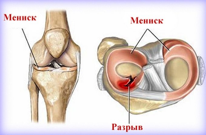 Здоровый мениск и разрыв мениска Разрыв мениска