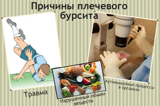 Причины возникновения бурсита плечевого сустава Причины бурсита плеча