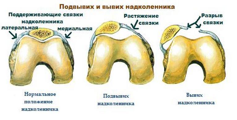 Здоровые связки, растяжение и разрыв связок коленного сустава Растяжение связок коленного сустава