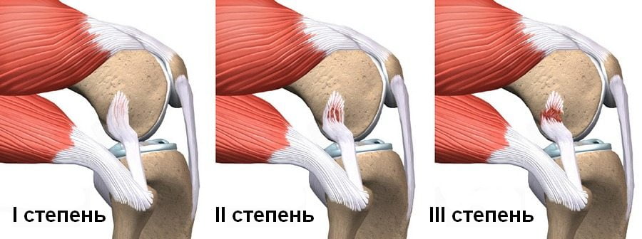 Степени растяжения связок коленного сустава Степени растяжения связок колена