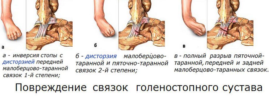 Стадии повреждения связок голеностопного сустава Стадии разрыва связок голеностопа