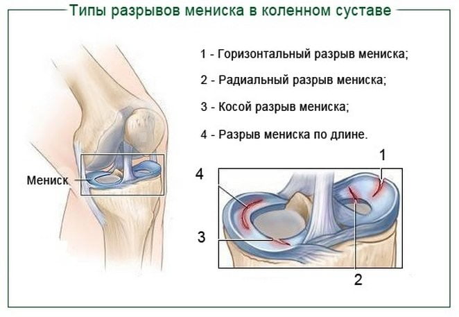 Типы разрывов мениска коленного сустава Типы разрывов мениска