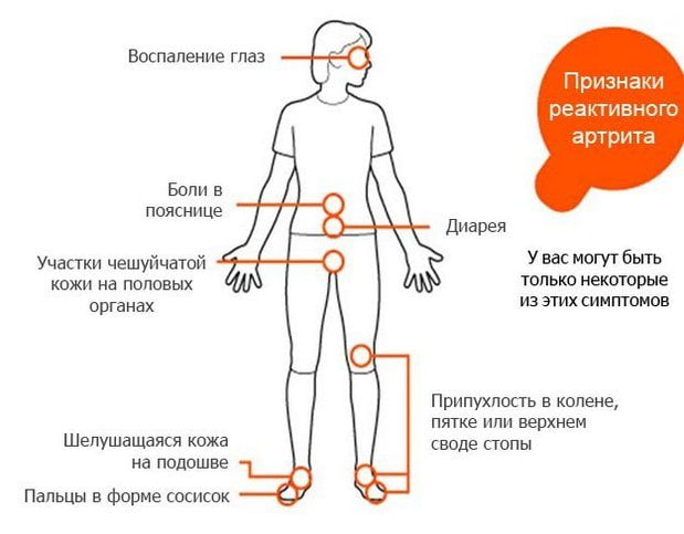 Признаки реактивного артрита Симптомы реактивного артрита