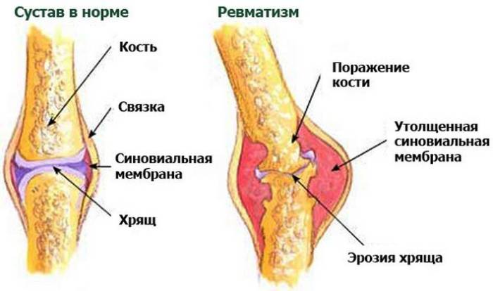 Здоровый и пораженный ревматизмом сустав Ревматизм