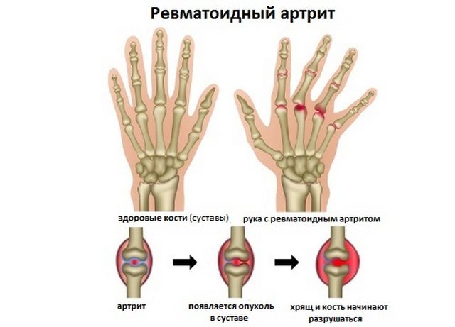 Здоровая и пораженная ревматоидным артритом кисть руки Ревматоидный артрит