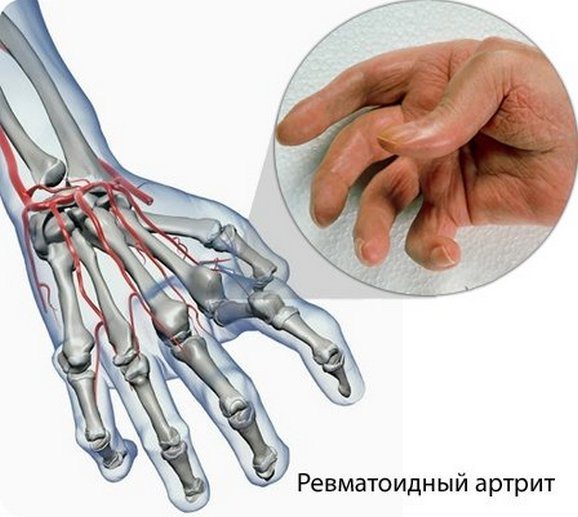 Ревматоидный артрит пальцев рук Ревматоидный артрит пальцев