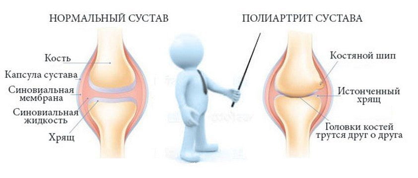 Здоровый и пораженный ревматоидным полиартритом сустав Ревматоидный полиартрит