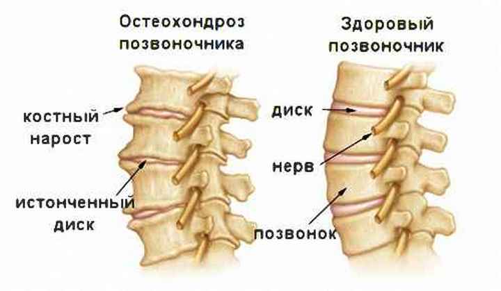Здоровый и пораженный остеохондрозом позвоночник Шейный остеохондроз