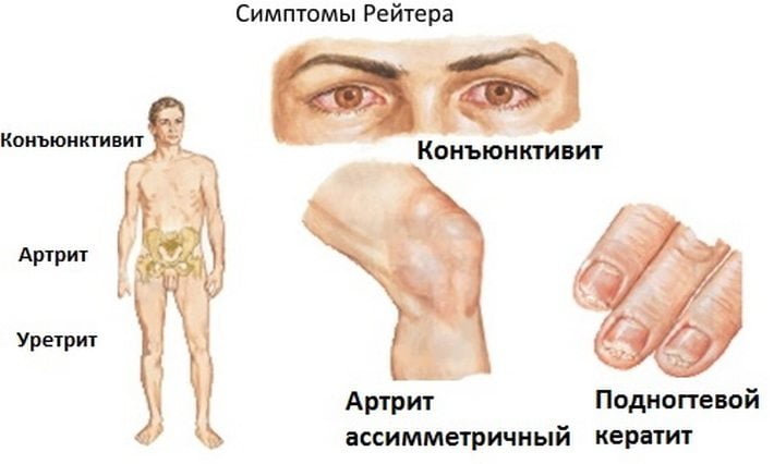 Симптомы синдрома Рейтера Симптомы болезни Рейтера