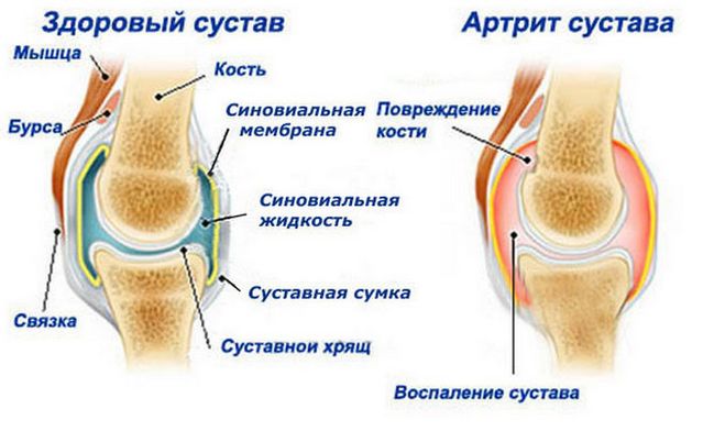 Сравнение здорового сустава и пораженного артритом Пораженный артритом сустав