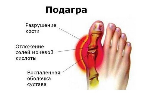 Подагра большого пальца ноги Подагра