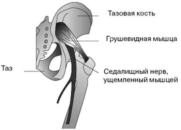 Седалищный нерв в тазобедренном суставе, ущемленный грушевидной мышцей Седалищный нерв ущемленный грушевидной мышцей